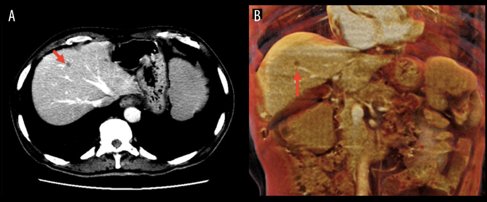 (A, B) Computed tomography scan showing a small, hypodense lesion in segment IVa of the liver (red arrow). Although the lesion was too small to be characterized, in the context of the colonic lesion, it was worrisome for metastasis.