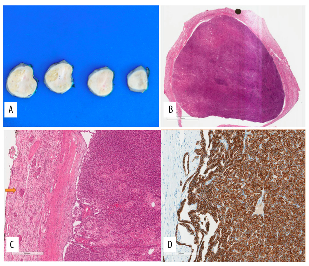 (A) Gross image of the left renal mass. A low-magnification microscopic image of the left renal mass (papillary renal cell carcinoma [RCC]). (B) There is a well-circumscribed proliferation of renal cells with early cystic-like formation. A higher-magnification microscopic image of the renal mass (type 1 papillary RCC). The tumor has a papillary architecture of tubular renal cells with basophilic cytoplasm and small monomorphic nuclei. (C) Unremarkable renal parenchyma (arrow) is adjacent to the tumor cells. A microscopic image of immunostaining of the papillary RCC. (D) The strong positivity for CK7 underscores the renal origin of the tumor.