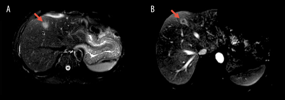 (A) Follow-up T2-weighted magnetic resonance image with fat saturation and (B) Post contrast T1-weighted image with fat saturation 1 month later demonstrate high T2 signal intensity and peripheral enhancement of the lesion, respectively, in keeping with metastasis from the colonic adenocarcinoma.