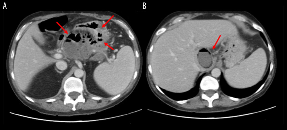 Contrast-enhanced abdominal computed tomography (CT), showing the presence of severe necrotizing pancreatitis with multiloculated collection containing both fluid and gas in pancreatic and peripancreatic tissues (A, B).