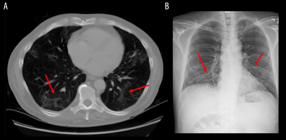 (A) Contrast-enhanced chest computed tomography (CT) showing bibasilar infiltrates in the lower lung fields and (B) chest x-ray showing nonspecific linear densities in lower lung fields. Both of these images are consistent with COVID-19 pneumonia.