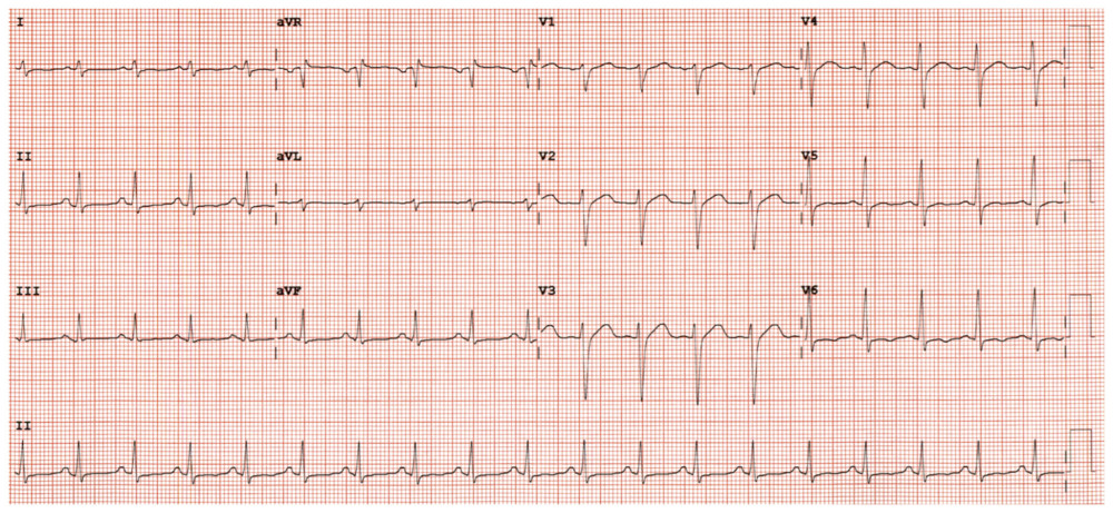 Electrocardiogram on day of chest pain onset.