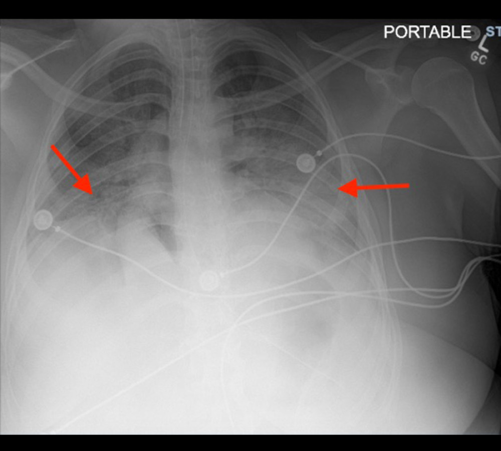 Chest X-ray on admission shows diffuse bilateral infiltrates (arrows).