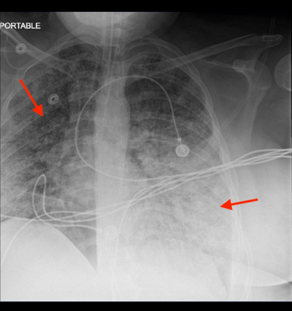 Chest X-ray on postoperative day 15 shows a worsening course with increased confluent opacities (arrows).