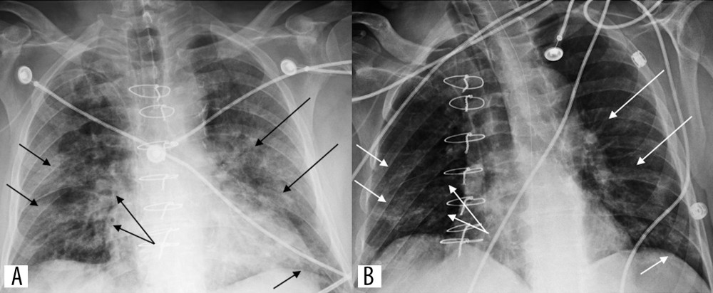 CXR (A) at presentation showing bilateral, ill-defined patchy airspace opacities and diffuse interstitial infiltrations. Improving opacities (B) through lung fields bilaterally on day 14 of treatment.