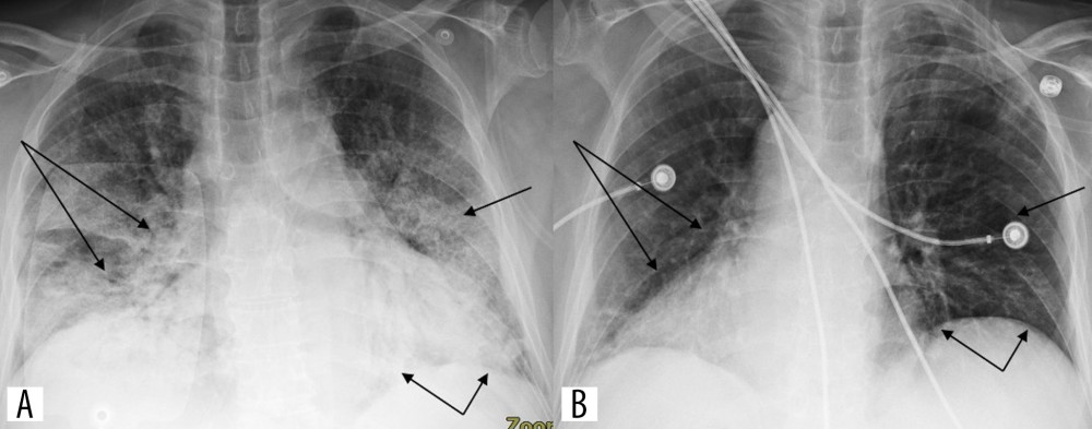 CXR (A) at presentation demonstrated diffuse interstitial prominence with bibasilar consolidations. Improving interstitial and airspace opacities (B) on day 14 of treatment.