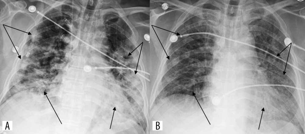 CXR (A) at presentation shows bilateral, diffuse, lower and middle zone predominant, interstitial and airspace opacities. Improving opacities (B) on day 14 of treatment.