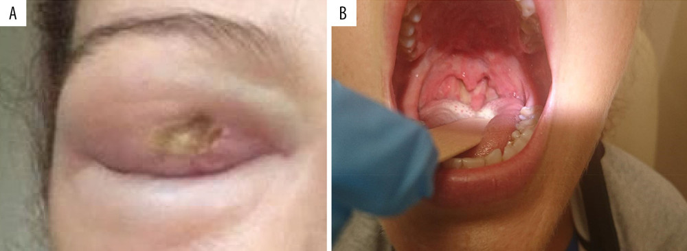 (A) Edema and ulceration of the right eyelid. (B) Ulceration of the uvula, hard palate, and palatine tonsils.