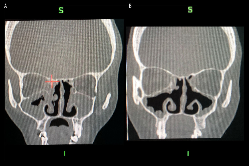 (A) CT scan coronal view: recurrent bilateral sinusitis. (B) Subsequent CT scan, coronal view.