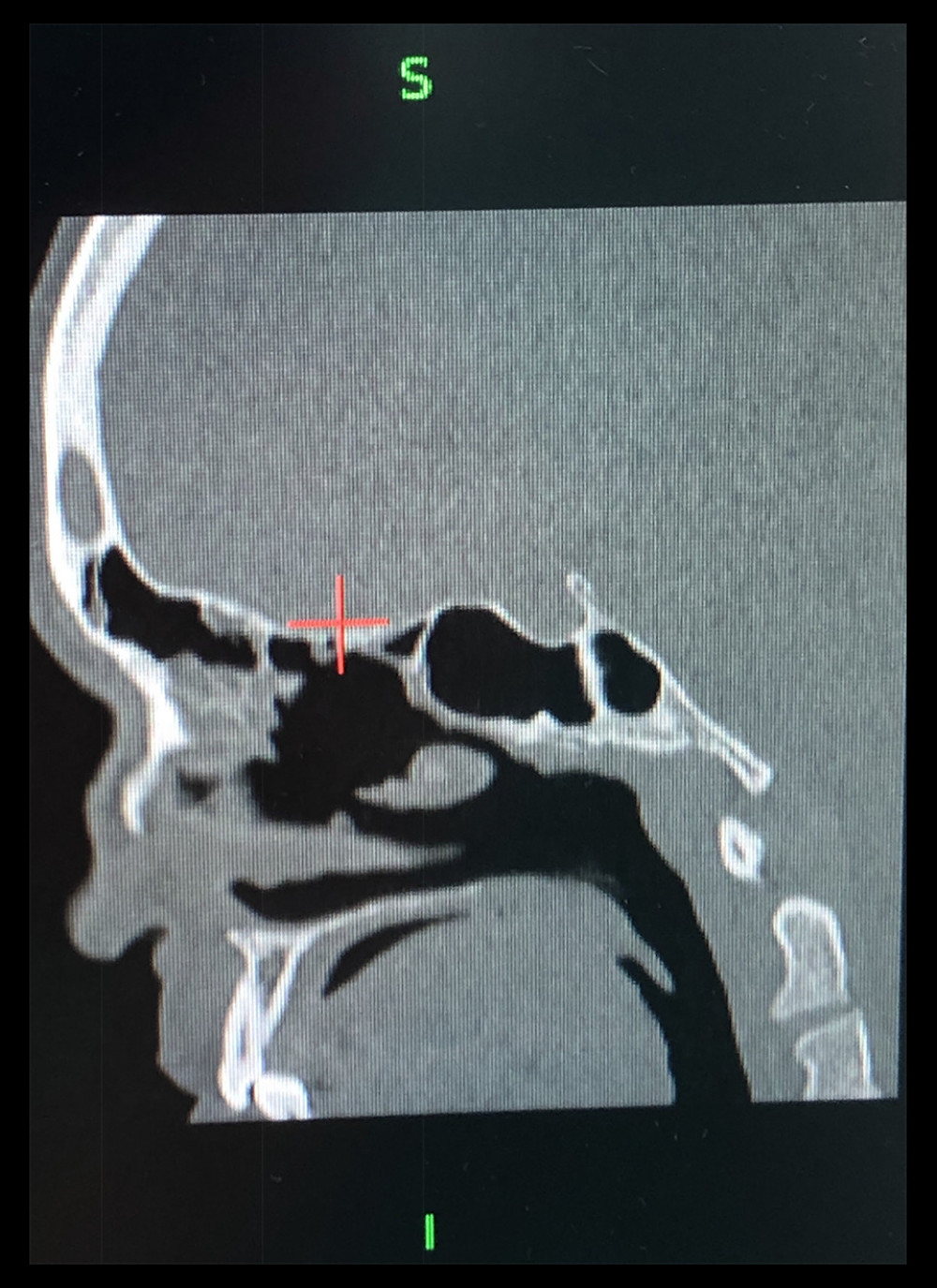 CT scan sagittal view: nasal septum perforation, nasal collapse, and deformation.