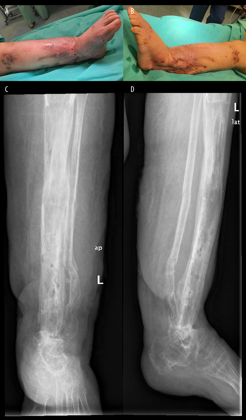 Clinical and radiological appearance of the leg after removal of the Ilizarov frame. (A) Anteroposterior clinical view. (B) Lateral clinical view. (C) Standard anteroposterior xray of the regenerated bone and ankle fusion and (D) standard lateral xray of the regenerated bone and ankle fusion.