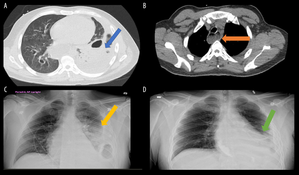 (A) CT of the chest shows empyema on the right lung; Blue arrow indicates empyema of the left lung. (B) CT of the chest showing dilation of distal esophagus; Orange arrow indicates dilated oesophagus. (C) CXR before chest tube insertion showing empyema; Yellow arrow indicated empyema air fluid level before insertion of chest tube. (D) CXR after chest tube insertion showing resolution of empyema; Green arrow indicates interval decrease in the air fluid level.