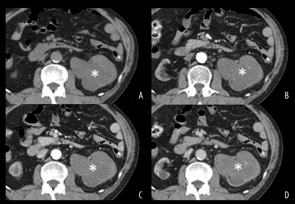 Computed tomography (CT) images of an acquired cystic disease-associated renal cell carcinoma in the 66-year-old man in Case Report 1. The left renal parenchyma is markedly thin and the dilated pelvis and calyx are filled with masses (*) without obvious enhancement in either phase (A–D). For the region of interest of a part of the lesion, the CT value of each phase was measured. (A) Plane phase (30 Hounsfield units [HUs]). (B) Corticomedullary phase (41 HUs). (C) Nephrographic phase (55 HUs). (D) Early excretory phase (42 HUs). There was no obvious calcification in the mass.