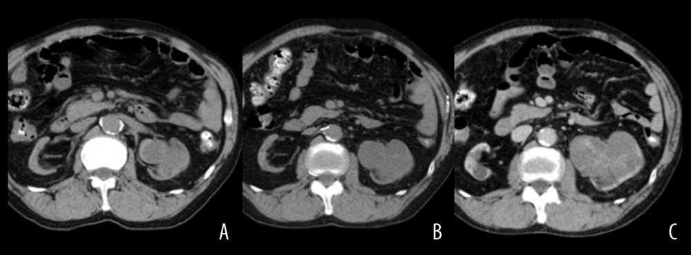 Comparison with computed tomography (CT) images of acquired cystic disease-associated renal cell carcinoma in the 66-year-old man in Case Report 1. (A) CT image 2½ years before total nephroureterectomy. (B) CT image 1½ years before total nephroureterectomy. (C) CT image 3 months before total nephroureterectomy. The mass filling the left renal pelvis and calyx slowly increased in size over 2½ years (A–C).
