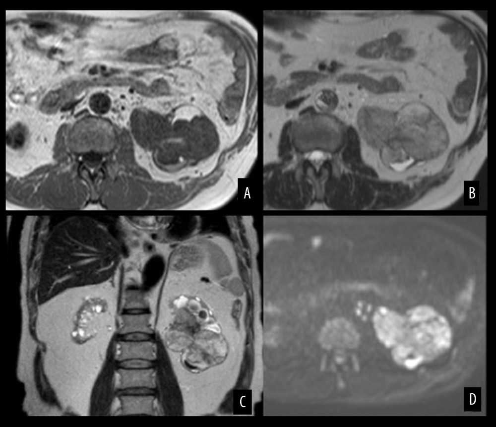 Magnetic resonance imaging of an acquired cystic disease-associated renal cell carcinoma in the 66-year-old man in Case Report 1. (A) An axial T1-weighted image shows a left pelvic tumor with heterogeneous low to high signal intensity, which suggests hemorrhage in the tumor. (B, C) Axial (B) and coronal (C) T2-weighted images show a left pelvic tumor with heterogeneous low to slightly high signal intensity. (D) A diffusion-weighted image shows a left pelvic tumor with heterogeneous high signal intensity.