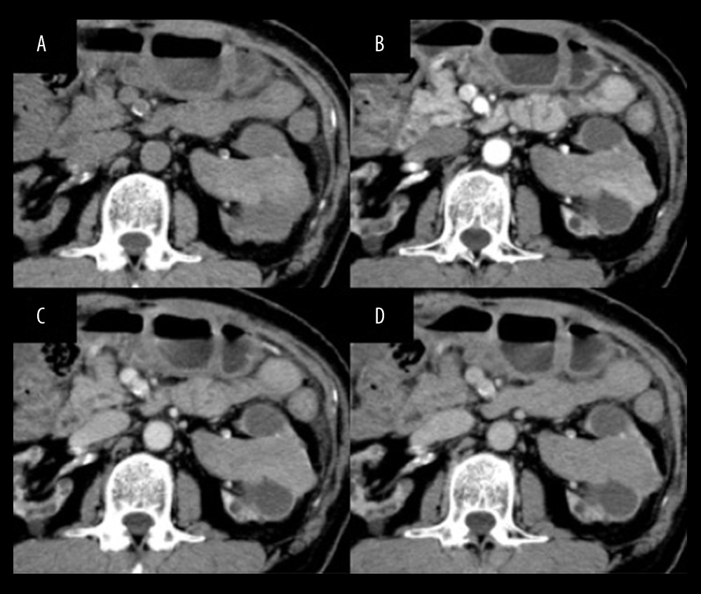 Computed tomography (CT) images of an acquired cystic disease-associated renal cell carcinoma in the 67-year-old man in Case Report 2. A left renal mass is seen filling the left renal pelvis with poor to slight enhancement on dynamic CT (A–D). For the region of interest of a part of the lesion, the CT value of each phase was measured. (A) Plane phase (57 Hounsfield units [HUs]). (B) Corticomedullary phase (92 HUs) (C) Nephrographic phase (77 HUs). (D) Early excretory phase (70 HUs).