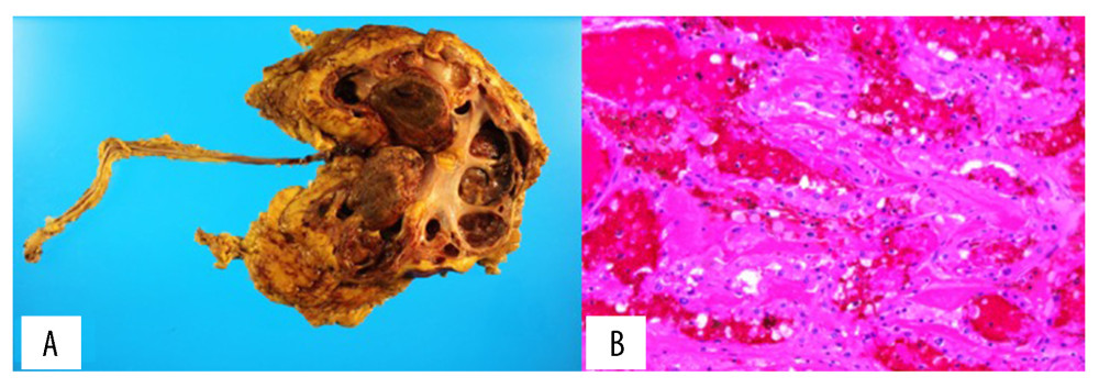 Findings from histopathological analysis of an acquired cystic disease-associated renal cell carcinoma in the 67-year-old man in Case Report 2. (A) The gross image shows a yellow solid tumor filling the left renal pelvis. (B) Microscopically, the tumor cells have abundant eosinophilic cytoplasm and prominent nucleoli.