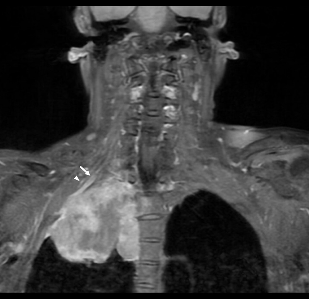 Coronal MRI image showing the mass invading the inferior (arrow) and middle (arrowhead) trunks of the right brachial plexus.