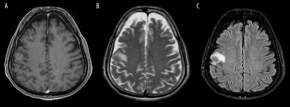 Axial MRI images showing right parietal lesion at the gray-white matter junction with enhancement in T1 post-contrast (A) and florid edema in T2 (B) and FLAIR (C) representing hematogenous metastasis.