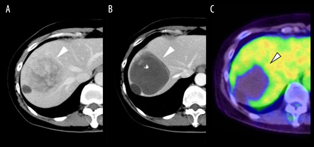 Changes in liver metastasis on enhanced computed tomography (E-CT) and 18F-fluorodeoxyglucose positron emission tomography/computed tomography (18F-FDG PET/CT) imaging. Liver metastasis (white arrowhead) found on E-CT 16 years and 10 months after surgery (A) were recognized as space-occupying lesions (white arrowhead) on E-CT 2 years later (B). 18F-FDG PET/CT showed no abnormal accumulation (white arrowhead) in that area (C).