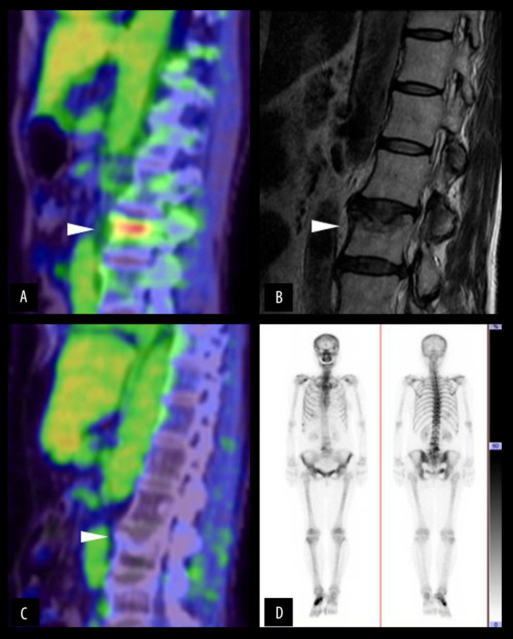 Changes in bone metastasis on 18F-FDG-PET/CT imaging, magnetic resonance imaging (MRI), and bone scintigraphy. 18F-FDG-PET/CT (A) and MRI (B) revealed bone metastasis in the 3rd lumbar vertebra (white arrowhead) in December 2014. Three years and 10 months later, 18F-FDG-PET/CT (C) showed no abnormal accumulation in the 3rd lumbar vertebra (white arrowhead). Bone scintigraphy in June 2019 showed no abnormal accumulation in the 3rd lumbar vertebra and no other bone metastases (D).