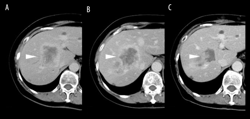 Changes in newly developed liver metastasis on E-CT imaging. Twenty-five years after surgery, E-CT (A) revealed newly developed liver metastasis (white arrowhead). E-CT after administration of eribulin mesylate for 8 months showed no reduction in liver metastasis (B). E-CT images after receiving 30 cycles of RF hyperthermia (C) (white arrowheads) showed liver metastasis that gradually reduced.