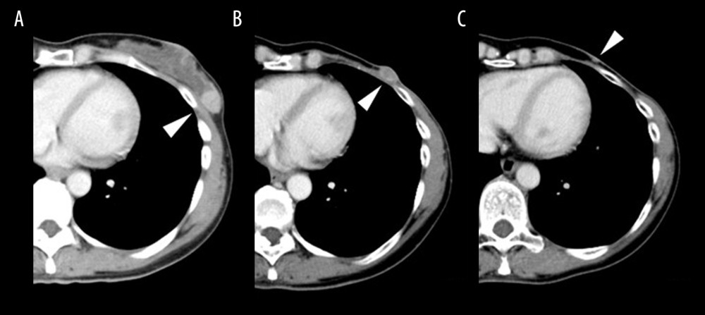 Primary breast cancer and recurrent lesions on E-CT imaging. E-CT on July 2007 (A) showed the primary breast cancer (white arrowhead). E-CT at 3 years and 8 months (B) and 4 years and 4 months (C) after the first surgery revealed the recurrent lesions (white arrowheads) in the left chest wall.