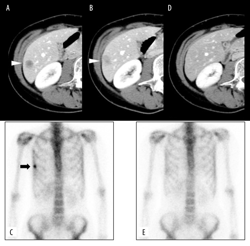 Changes in liver metastasis on E-CT and bone metastasis on bone scintigraphy. E-CT 6 years and 9 months after the first surgery (A) revealed liver metastasis (white arrowhead). Six months later, E-CT (B) showed the enlargement of liver metastasis (white arrowhead), and bone scintigraphy (C) showed bone metastasis in right 6th rib (black arrow). After 2 years and one month with oral S-1 chemotherapy, both liver and bone metastases disappeared on CT (D) and bone scintigraphy (E).