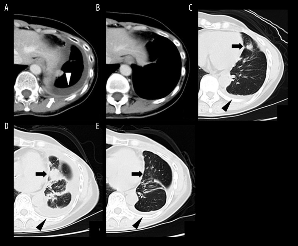 Changes in the pleural effusion, pleural thickening, and lung metastasis on CT. E-CT in May 2017 (A) showed the pleural effusion (white arrowhead) and pleural thickening (white arrow). E-CT 5 months later (B) revealed disappearance of pleural effusion and pleural thickening. On CT in January 2019 (C), left pleural effusion was observed again (black arrowhead) and a nodular shadow appeared in the lingular division of the left lung (black arrow). CT in September 2019 (D) revealed increased pleural effusion (black arrowhead) and an enlarged nodular shadow (black arrow). E-CT performed after receiving of RF hyperthermia (E) showed disappearance of lung metastasis (black arrows) and decrease in pleural effusion (black arrowheads).