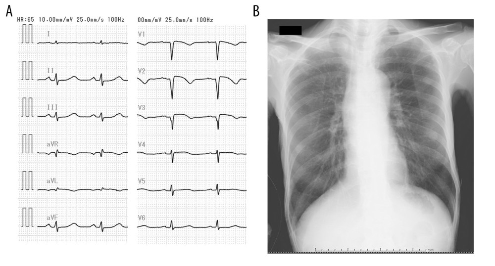 (A) Electrocardiogram at admission showing ST elevation of V2–V3 and poor R-wave enhancement of the anterior precordial lead. (B) Chest X-ray at admission.