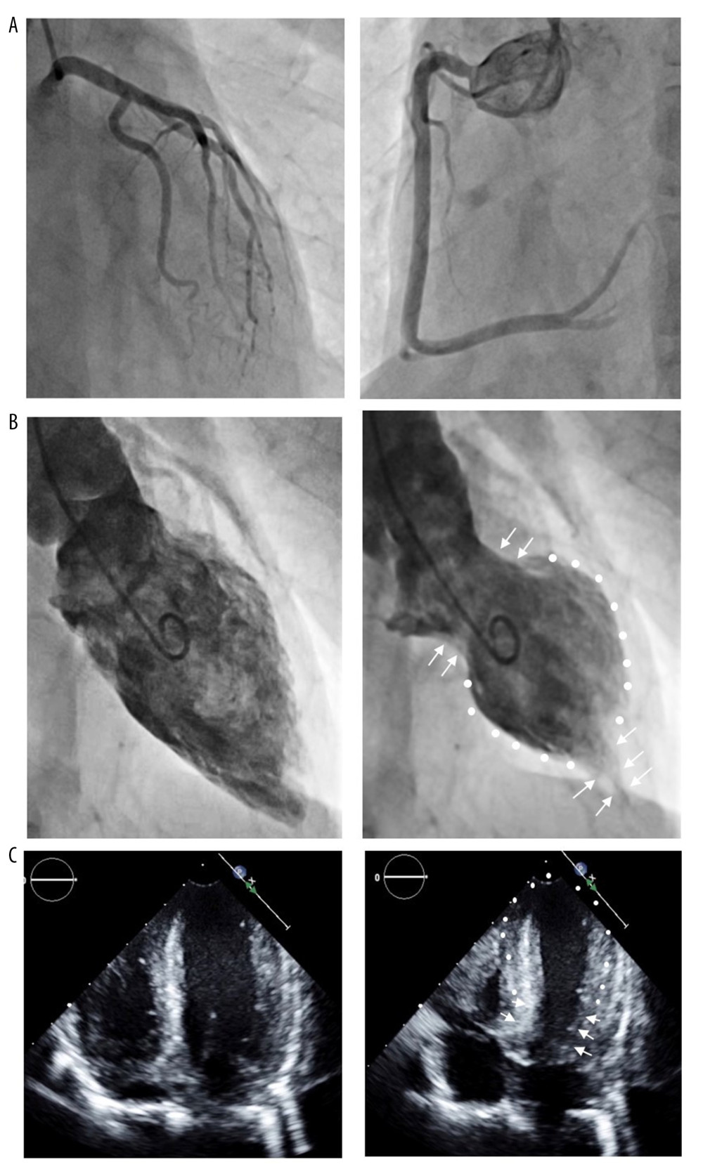 (A) Coronary angiogram of right coronary artery (right side) and left coronary artery (left side). There were no significant stenotic lesions. (B) Left ventricular (LV) angiogram of end-diastolic phase (left side) and end-systolic phase (right side). LV wall motion was decreased in the middle of LV (white dots) and the hyperkinetic motion was seen in the base and apical portion of the LV (white arrows). (C) Transthoracic echocardiogram of LV of end-diastolic phase (left side) and endsystolic phase (right side) 1 week after the onset. LV wall motion showed that a typical pattern of the apical ballooning was observed (white dots) and the hyperkinetic motion was seen in the base of the LV (white arrows).