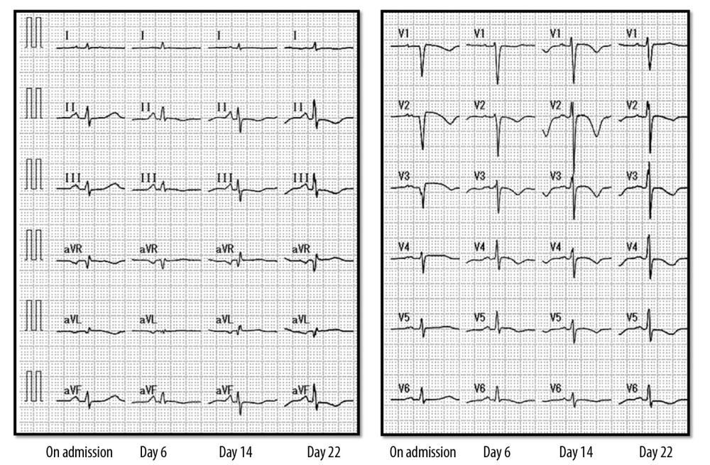 Changes of electrocardiogram during the course. The ST elevation of V2–V3 and the poor progression of R-wave enhancement of the anterior precordial lead on admission were improved. Then, a negative inversion of T wave of the anterior precordial lead that peaked appeared on day 14, and then improved.
