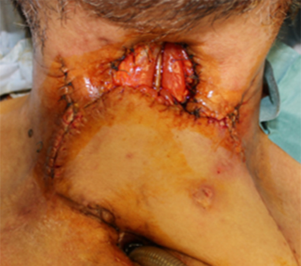 Preoperative view. This pharyngeal cutaneous fistula was constructed to control local infection. A bi-paddled pectoralis major flap reconstruction was planned to close the fistula.