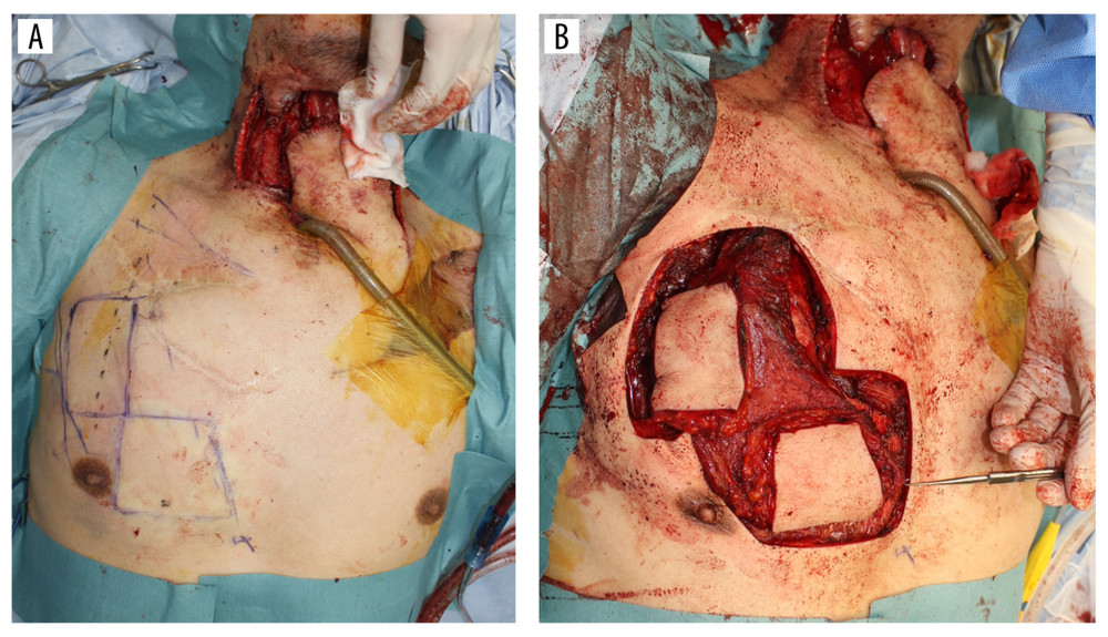 Operative view. (A) The design of bi-paddled pectoralis muscle flap. (B) The bi-paddled pectoralis major flap was harvested. The anterior pharyngeal wall was reconstructed at the medial skin island, and the outer skin island was folded back to reconstruct cervical soft tissue.