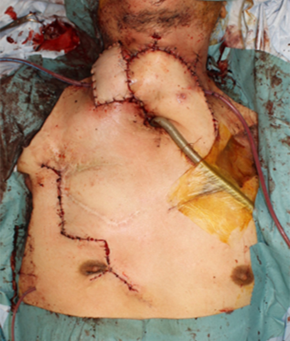 Postoperative view. The donor site did not require skin grafting and could be closed temporarily.