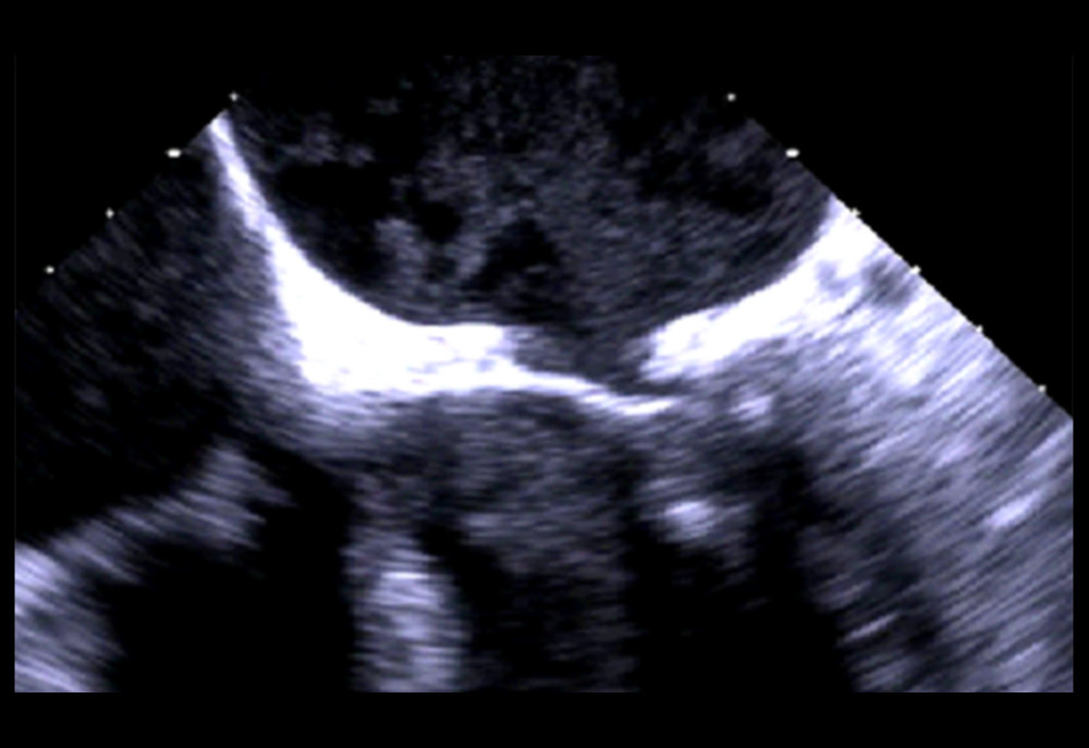 Preoperative transesophageal echocardiogram (TEE) showing mitral valve vegetation in a 43-year-old man with a history of systemic lupus erythematosus (SLE) who presented with endocarditis associated with Q fever due to infection with Coxiella burnetii. The TEE was performed in 2018 and shows impaired closure of the mitral valve leaflets (malcoaptation) associated with valve vegetation.