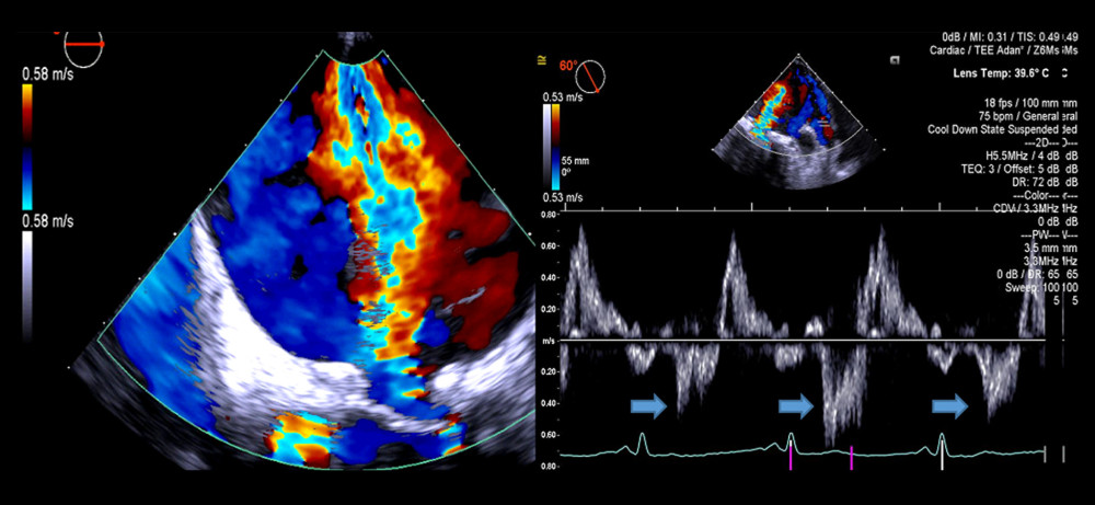 Preoperative transesophageal echocardiogram (TEE) showing severe mitral regurgitation with color Doppler and systolic flow reversal of the pulmonary vein in a 43-year-old man with a history of systemic lupus erythematosus (SLE) who presented with endocarditis, which was later diagnosed to be an infection with Coxiella burnetii. The TEE was performed in 2018.