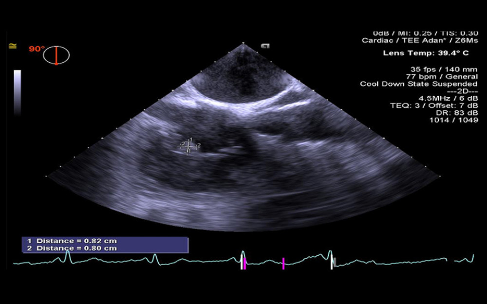 Preoperative transesophageal echocardiogram (TEE) of a 43-year-old man with a history of systemic lupus erythematosus (SLE) who presented with endocarditis associated with Q fever due to infection with Coxiella burnetii. The image, which shows a mass on the repaired tricuspid valve, was taken in 2018.
