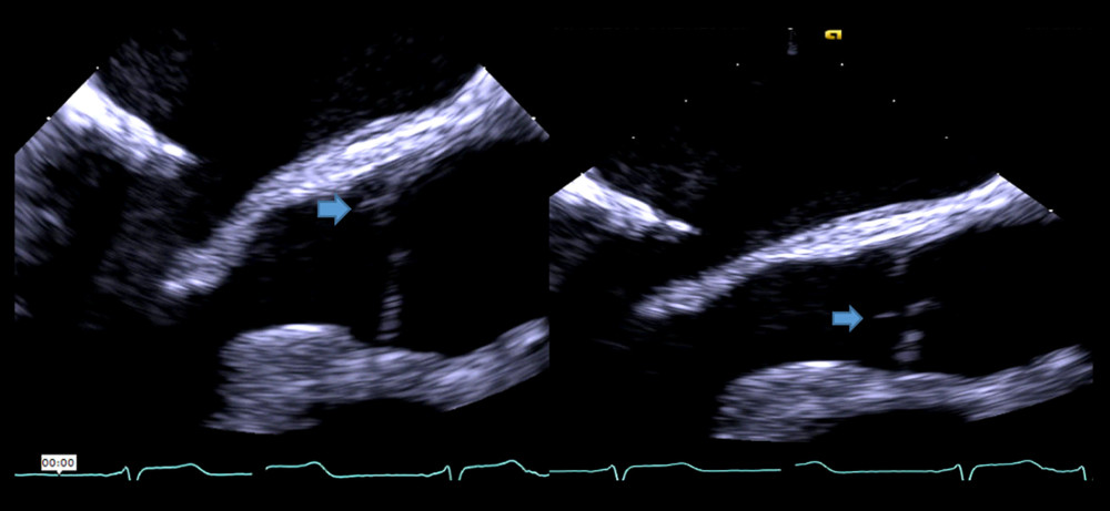 Transesophageal echocardiogram (TEE) showing multiple small, flickering masses post-Ross procedure on the aortic valve (native pulmonary valve) of a 43-year-old man with a history of systemic lupus erythematosus (SLE) who presented with endocarditis, which was later diagnosed to be an infection with Coxiella burnetii. The TEE was performed in 2019.