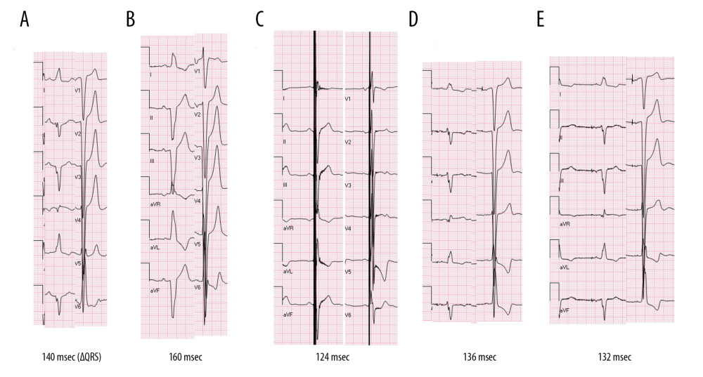 Changes in electrocardiogram parameters (QRS complex) over the course of the treatment. (A) Initial assessment. (B) Third admission (just before CRT pacemaker implantation). (C) Immediately after implantation of CRT pacemaker implantation (biventricular pacing). (D) Immediately after discontinuation of CRT. (E) Most recent assessment, 6 years after CRT discontinuation. CRT – cardiac resynchronization therapy.