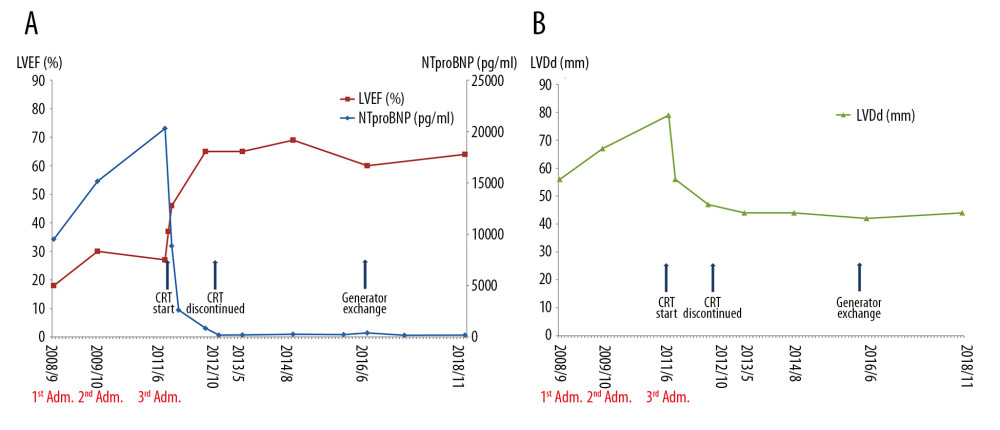 Change in each parameter and events that occurred over the course of treatment. (A) LVEF, NT-pro BNP, (B) LVDd. LVEF – left ventricular ejection fraction; LVDd – left ventricular diastolic dimension; NT-pro BNP – NT-proB-type natriuretic peptide.