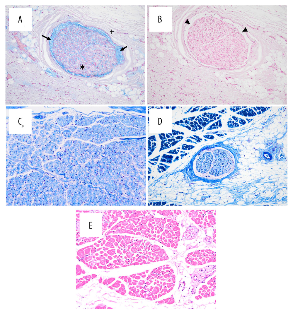 Histological findings on autopsy. (A) Alcian Blue staining and (B) hyaluronidase staining of peripheral nerves. Spaces that were positive for Alcian Blue staining (arrows) and negative for hyaluronidase staining (arrow head) were observed around the peripheral nerves. Retention of mucus was observed around and among the peripheral nerves of the peripheral nerves. * Axis cylinder. + myelin sheath. Original magnification ×20. (C, D) Klüver-Barrera staining of proximal peripheral nerves revealed demyelination. Original magnification ×20 for (C) and ×10 for (D). (E) Hematoxylin and eosin staining of respiratory muscles. Highly atrophic changes were observed. Original magnification ×10.