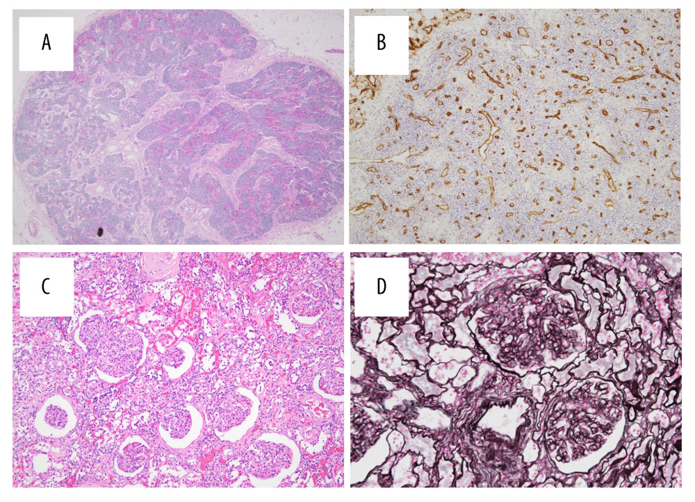 (A) Hematoxylin and eosin staining of lymph nodes (original magnification ×4) and (B) CD34 immunostaining of lymph nodes (original magnification ×10). Overall, lymph nodes were atrophic, and high endothelial venules were relatively notable. (C, D) Renal histological findings include a membranoproliferative glomerulonephritis-like appearance. (C) Hematoxylin and eosin staining (original magnification ×10) and (D) periodic acid methenamine silver staining (original magnification ×20). Almost all glomeruli showed lobular formation with mesangial proliferation. Many large glomeruli showed crescent formation.