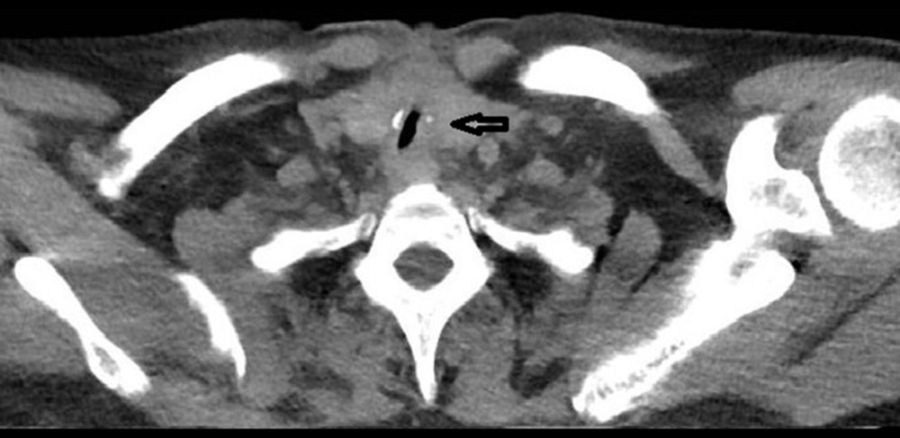 Case 1. Lung computed-tomography (CT) image from a 54-year-old man with coronavirus disease 2019 pneumonia who required tracheostomy for mechanical ventilation. Ten days after hospital discharge, the patient returned with respiratory distress. The CT scan shows tracheal stenosis (arrow) with clear lung fields.