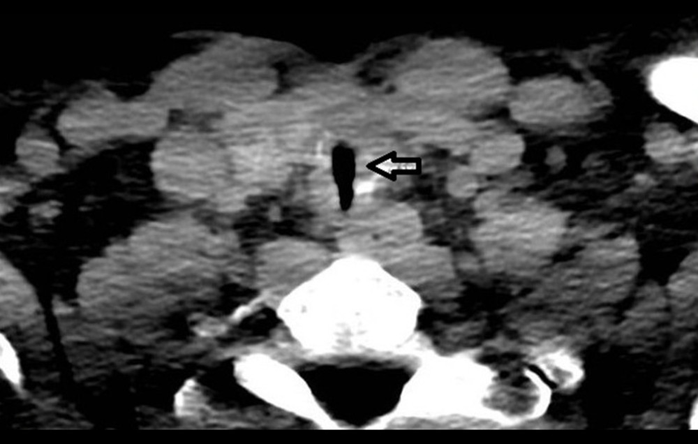 Case 2. Lung computed-tomography (CT) image from a 43-year-old man with coronavirus disease 2019 pneumonia who required tracheostomy for mechanical ventilation. Eighteen days after hospital discharge, the patient returned with respiratory distress. The CT scan shows tracheal stenosis (arrow) with clear lung fields.