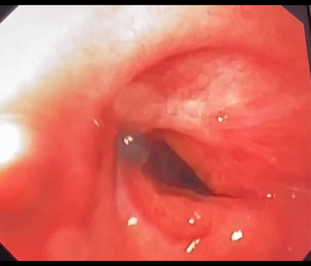 Case 2. Bronchoscopic image from a 43-year-old man with coronavirus disease 2019 pneumonia who required tracheostomy for mechanical ventilation. The bronchoscopy shows the tracheal stenosis that occurred 18 days after hospital discharge.