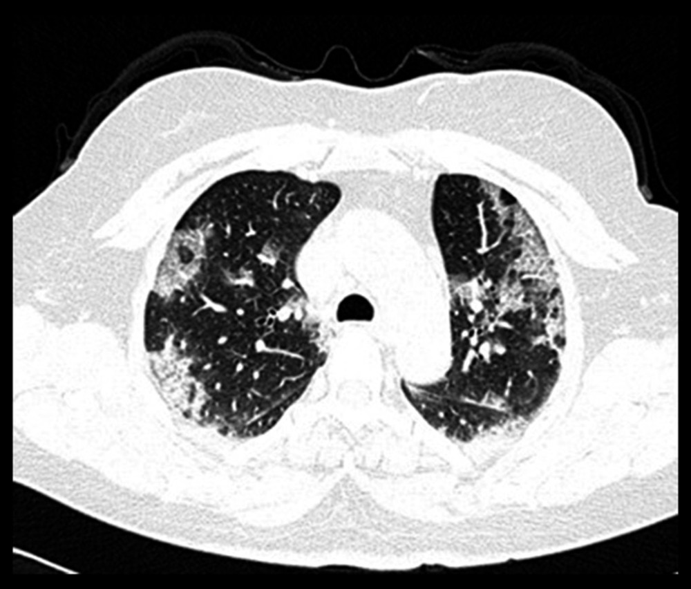 CT scan. Axial cut with the presence of ground-glass opacities, some of them with a tendency to consolidation in both lung fields, in a patient with COVID-19.
