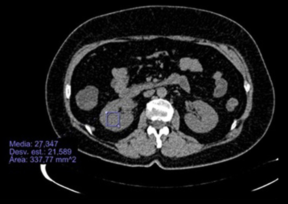 CT scan. Axial cut with slightly hypodense renal parenchyma in a patient with COVID-19.
