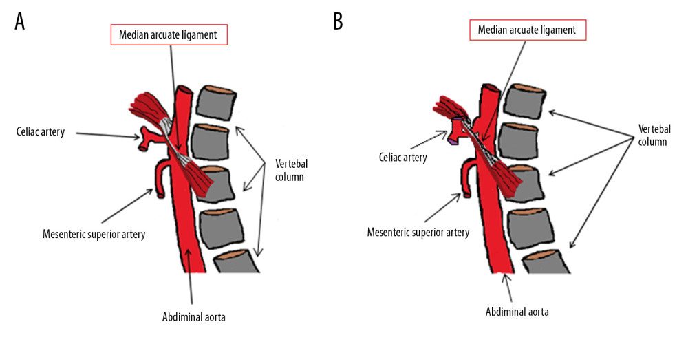 Summary diagram of the anatomical structures involved in healthy patients and in those with DS. (A) Healthy patient with regular celiac artery caliber and regular course of the MAL. (B) Patient with the syndrome, with celiac artery compression by the MAL.