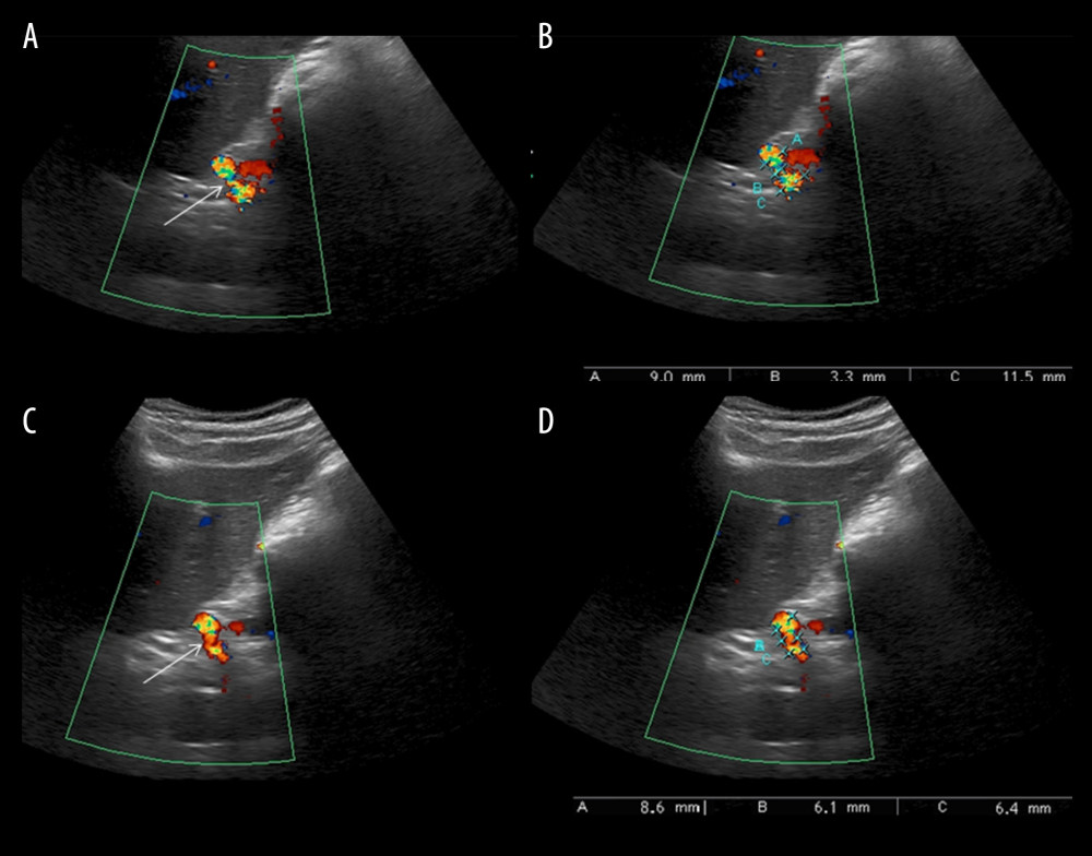 Color Doppler US examination. (A) In scans performed in expiratory apnea, the color Doppler US shows the stenosis of the celiac artery (arrow) and the chromatic aliasing due to the high peak speeds and turbulent flow. (B) Caliper measurements highlight a severe stenosis with post-stenotic dilation in the celiac artery. (C) In the scans, performed in inspiratory apnea, the color Doppler US still shows chromatic aliasing due to the turbulent flow. (D) Measurements of the caliber show a slight reduction in stenosis and pre- and post-stenotic dilatation of the celiac artery.